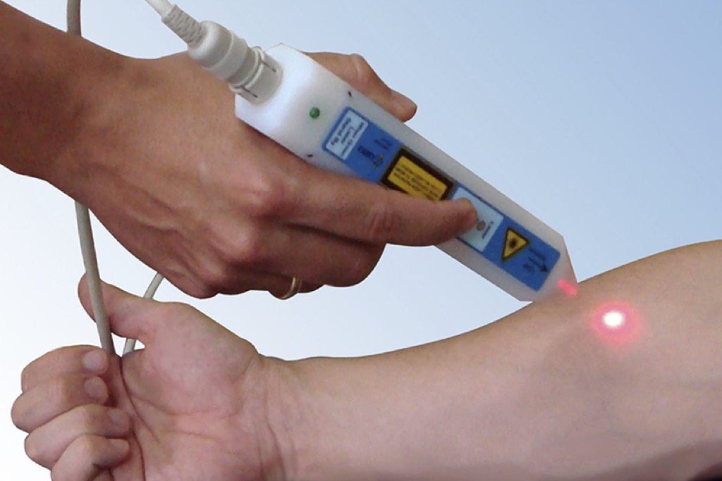 Laserterapia — aplicação do laser terapêutico no antebraço